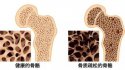 黄色视频免费观看网站仪：骨质疏松十大认知误区（上）