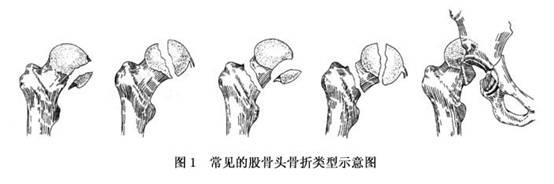 股骨头黄色视频免费观看网站增加是什么意思？平睡左腿收起左右摆动大点大腿根就痛。