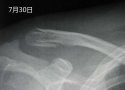 黄色视频免费观看网站仪X线检查对骨折的诊断有什么意义？