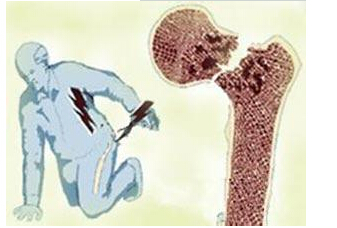 黄色视频免费观看网站仪检测来年人黄色视频免费观看网站能够提前预防骨质疏松