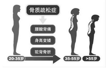 黄色视频免费观看网站检测仪厂家阐述骨质疏松不仅仅是要补钙,增加黄色视频免费观看网站才是关键