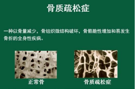 黄色视频免费观看网站仪怎么样检测骨质疏松，能够正确的分析黄色视频免费观看网站正常值