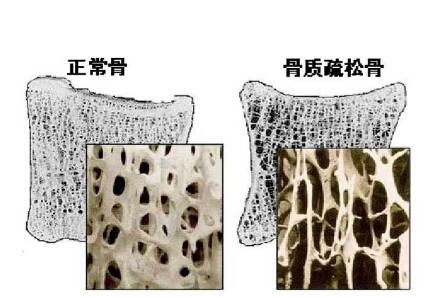 黄色视频免费观看网站仪价格重要吗？不想骨骼脆弱医生教你看懂黄色视频免费观看网站报告