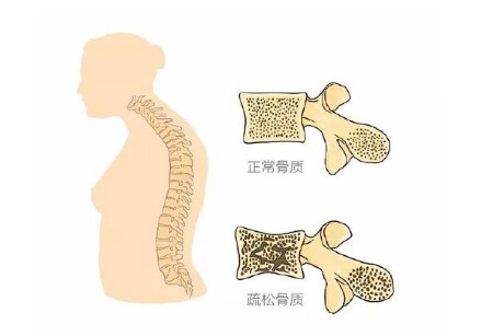 黄色视频免费观看网站仪生产厂家阐述警示骨质疏松 三种症状不容小觑