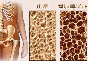 黄色视频免费观看网站测试是通过黄色视频免费观看网站检测仪器测试你是否患有骨质疏松症
