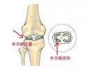 624河南信阳|黄色视频下载网站超声波黄色视频免费观看网站仪厂家今日资讯：了解并正确保护膝关节半月板